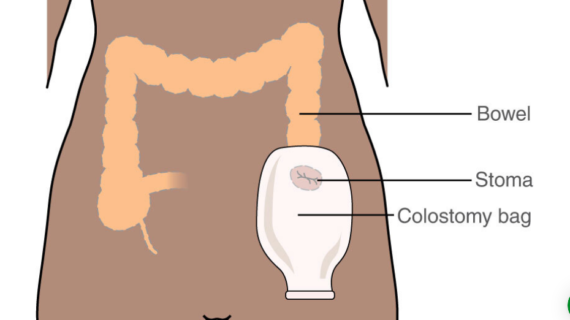 बड़ी आंत व मलाशय कैंसर के 40% रोगियों को स्टोमा चिकित्सा की आवश्यकता पड़ती है -डॉक्टर नसीम अख्तर