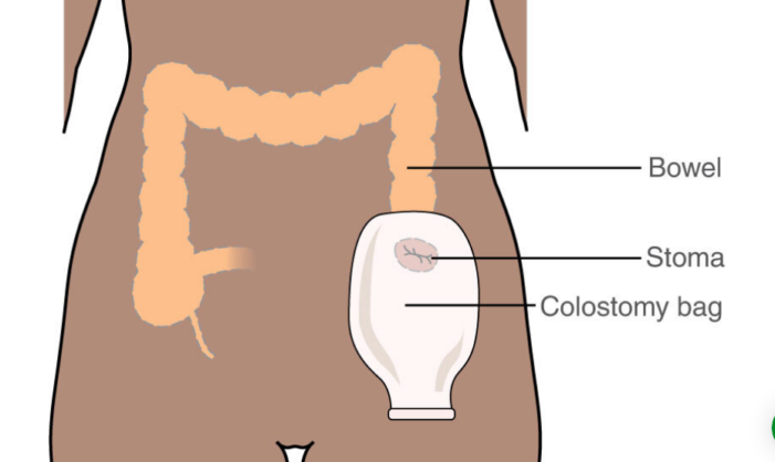 बड़ी आंत व मलाशय कैंसर के 40% रोगियों को स्टोमा चिकित्सा की आवश्यकता पड़ती है -डॉक्टर नसीम अख्तर